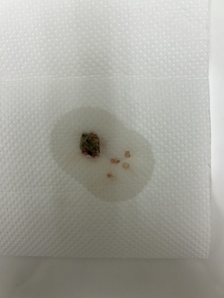 膀胱結石