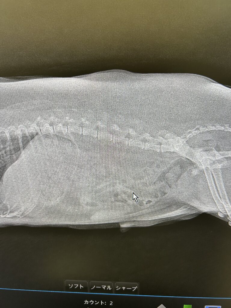 前立腺尿道内の結石